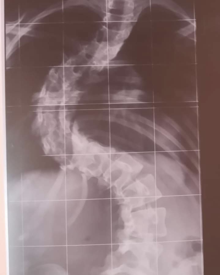 Jacareiense cria vaquinha para custear cirurgia de escoliose